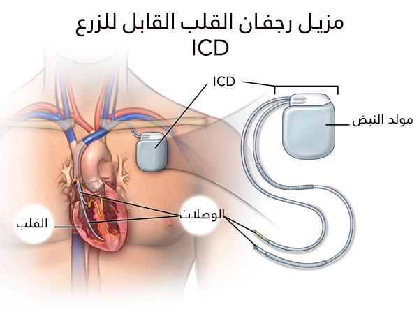 بتألف مزيل الرجفان من مولد للنضات ووصلات تنتهي في حجرات القلب