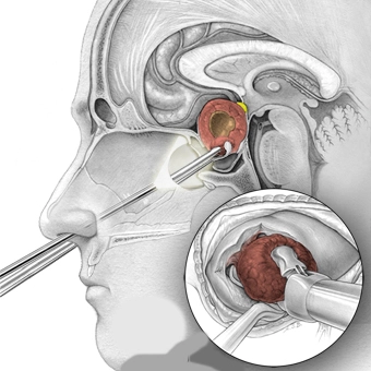 تم استئصال ورم الغدة النخامية باستخدام منظار مزود بأدوات جراحية