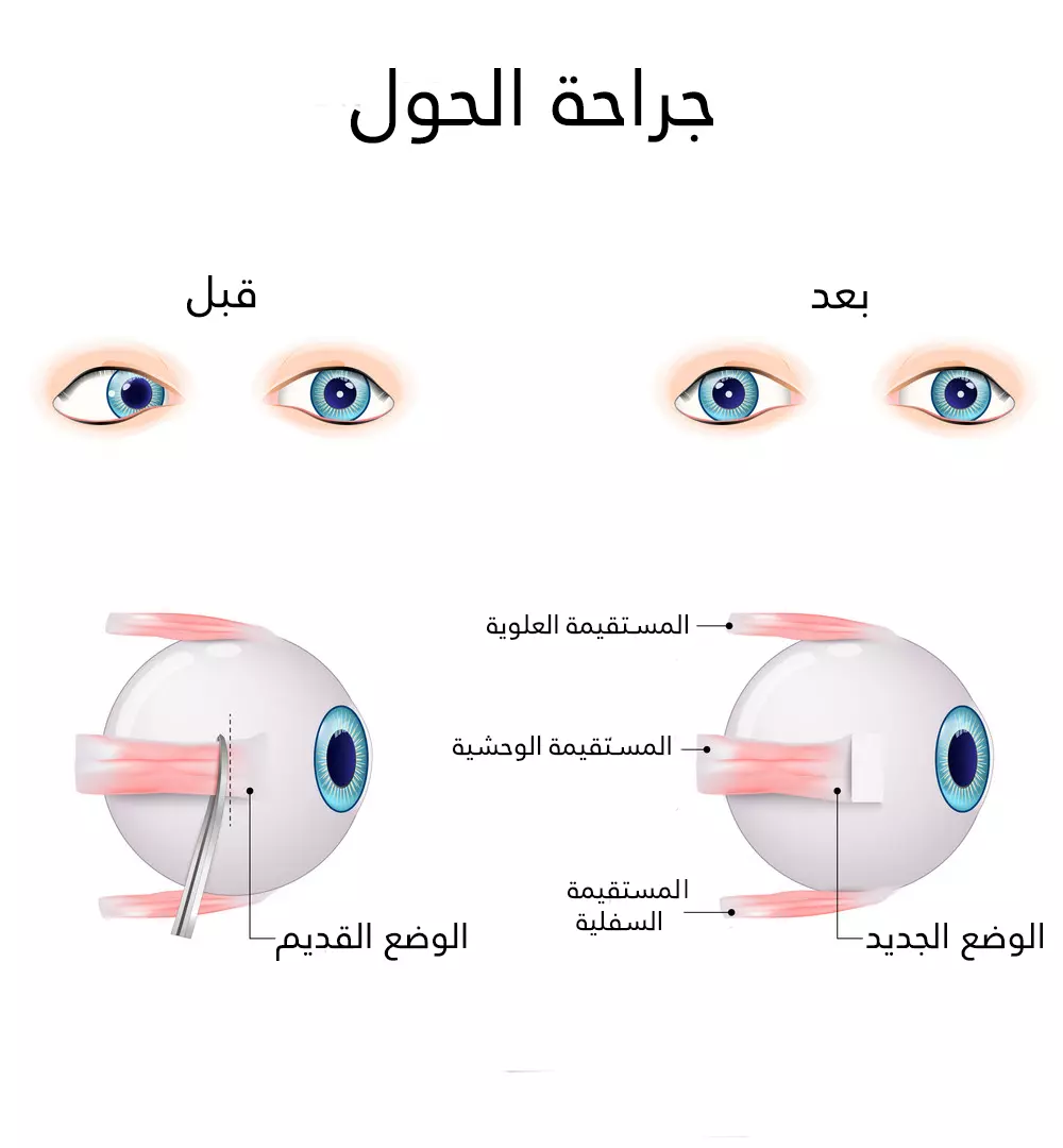 تم تقصير العضلة المستقيمة الوحشية لتصحيح الحول