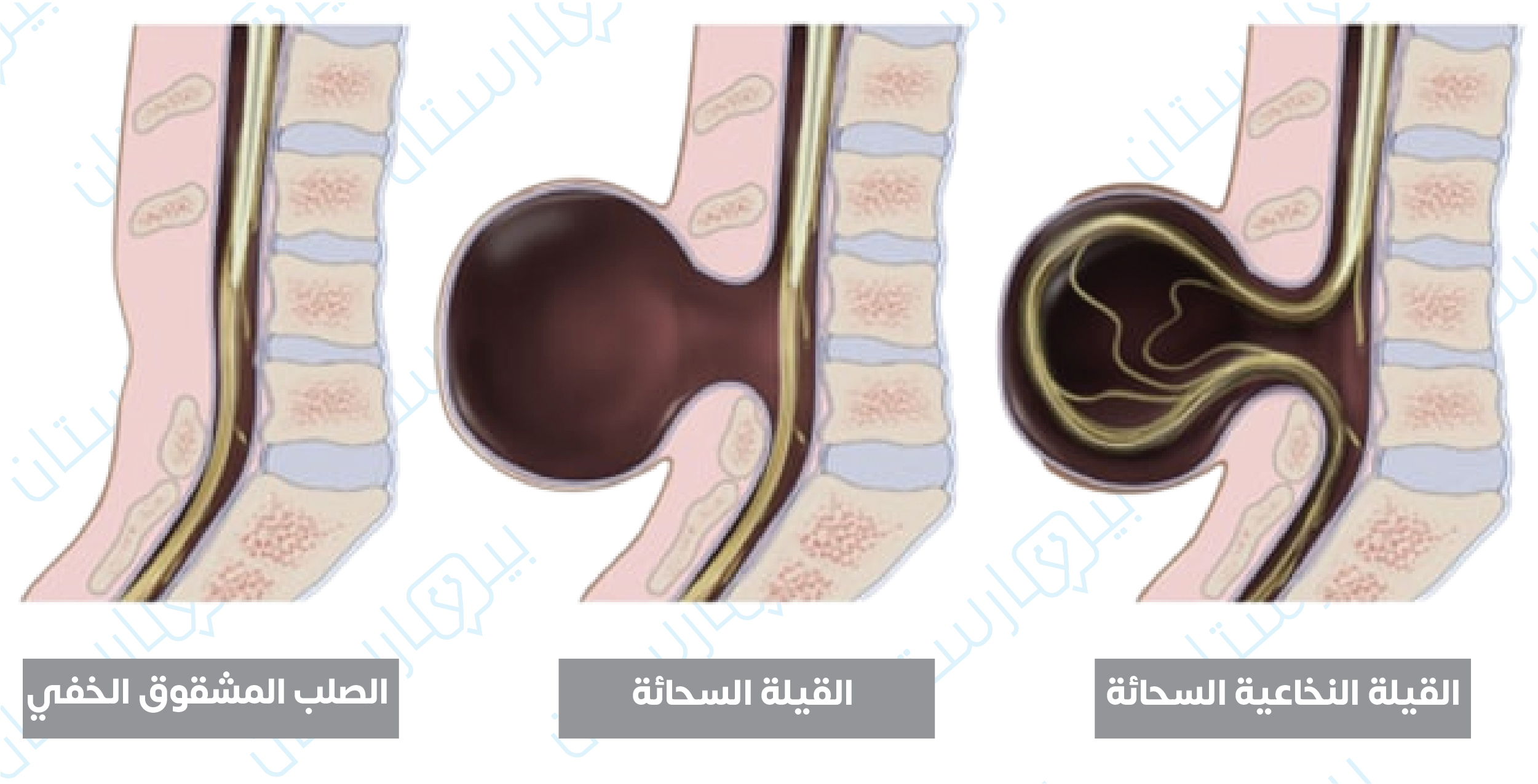 أنواع الصلب المشقوق وفقاً للمحتويات الخارجة عبر الانشقاق