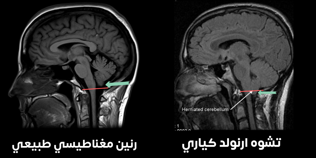 صورة رنين مغناطيسي توضح انقتاق المخيخ عبر الثقبة الكبيرة في سياق متلازمة ارنولد كياري