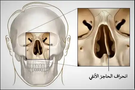 ينحرف الحاجز الأنفي عن الخط الناصف