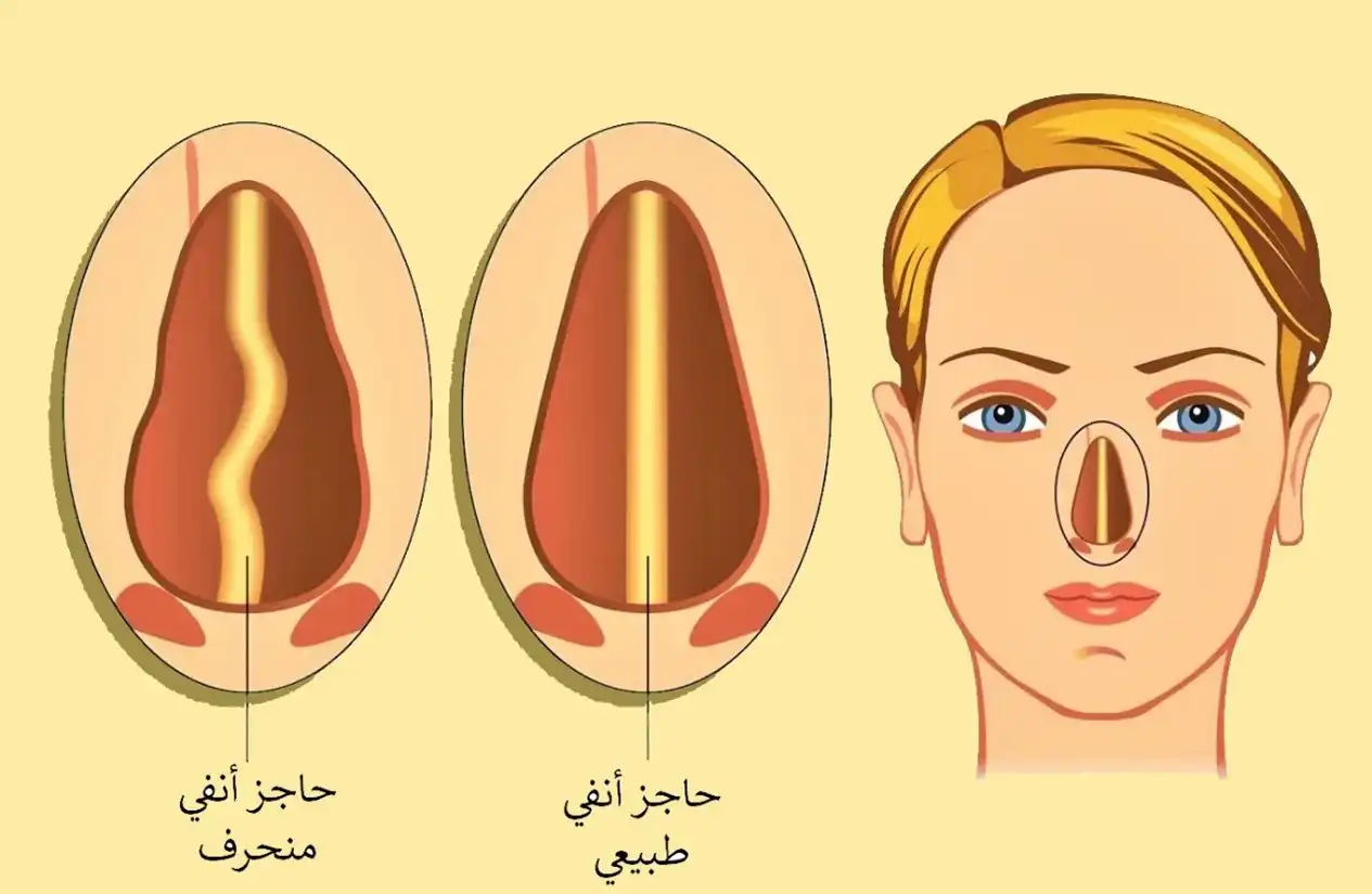 صورة لحاجز أنفي طبيعي وحاجز أنفي منحرف