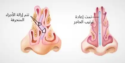 تتم إزالة الأجزاء المنحرفة ومن ثم إعادة ترتيب الحاجز