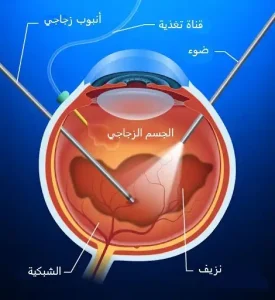 اعتلال الشبكية السكري 7 رسم توضيحي لعملية استئصال الزجاجية