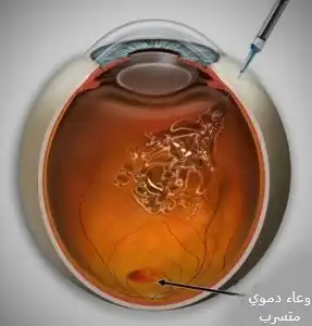 اعتلال الشبكية السكري 6 رسم يبين إعطاء حقنة مضاد Vegf