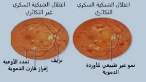 اعتلال الشبكية السكري 3 صورة توضح الفرق بين اعتلال الشبكية السكري المبكر و المتقدم