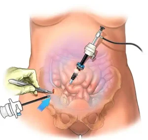 علاج الفتق البطني بالتنظير