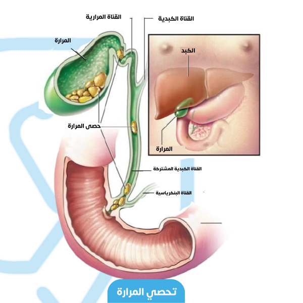 تتشكل الحصيات المرارية في المرارة ثم تتراكم في الطرق الصفراوية وتسدها