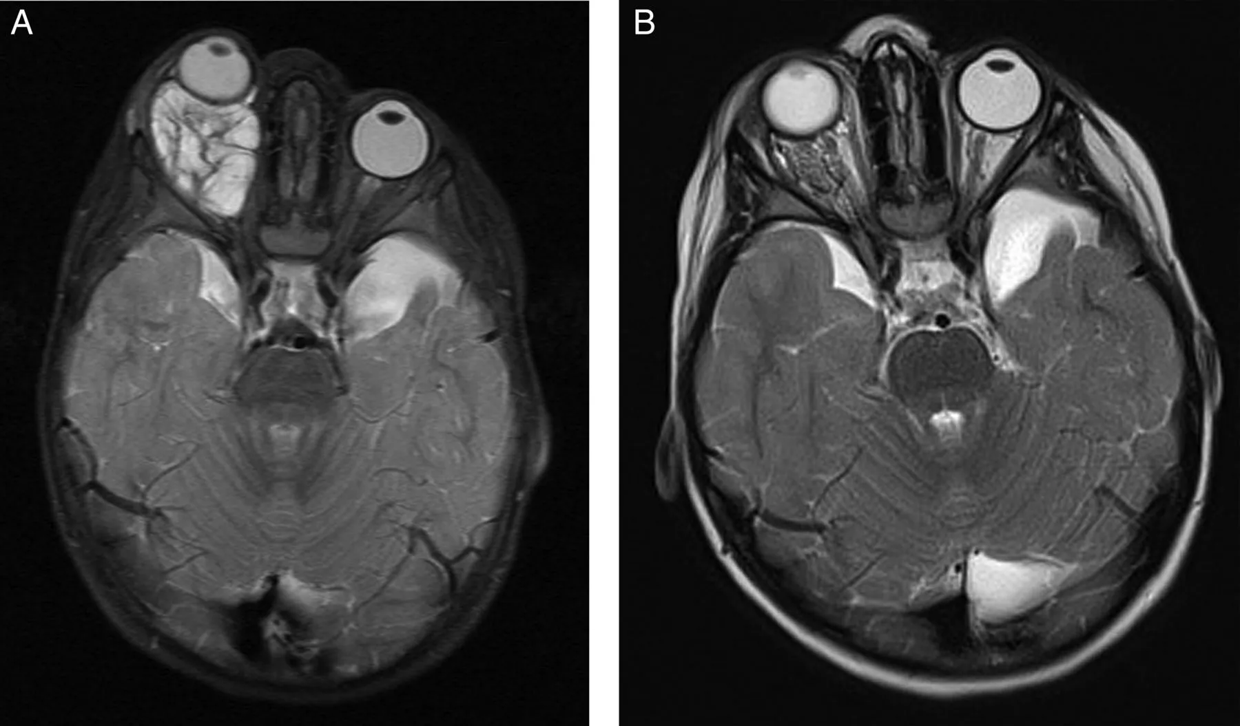 تم أخذ صورة رنين مغناطيسي Mri لمريض مصاب بورم وعائي لمفاوي خلف عينه، وتمت إعادة الصورة بعد علاجه بالتصليب في تركيا