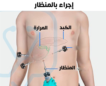 لاحظ الشقوق الجراحية الصغيرة في عملية استئصال المرارة بالمنظار