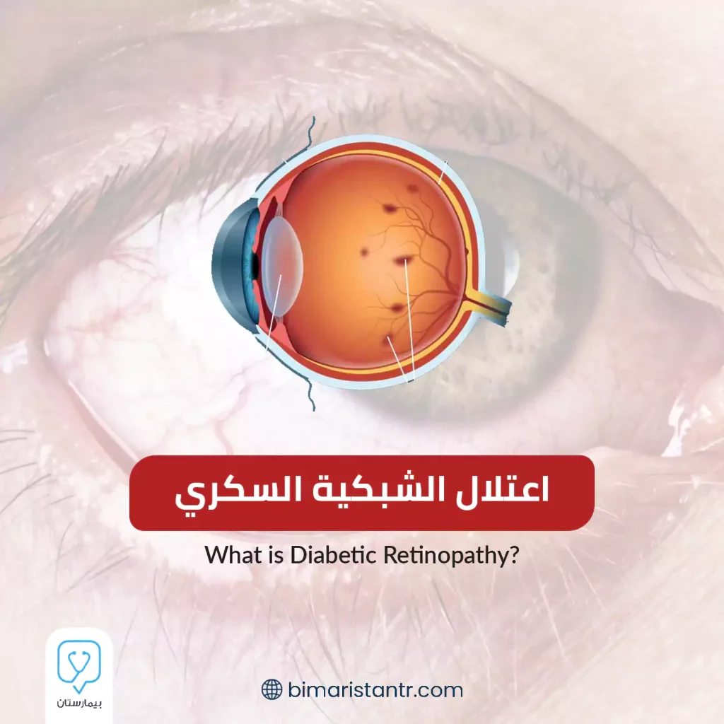 اعتلال الشبكية السكري 1