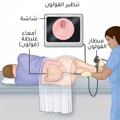 كيفية إجراء عملية تنظير القولون