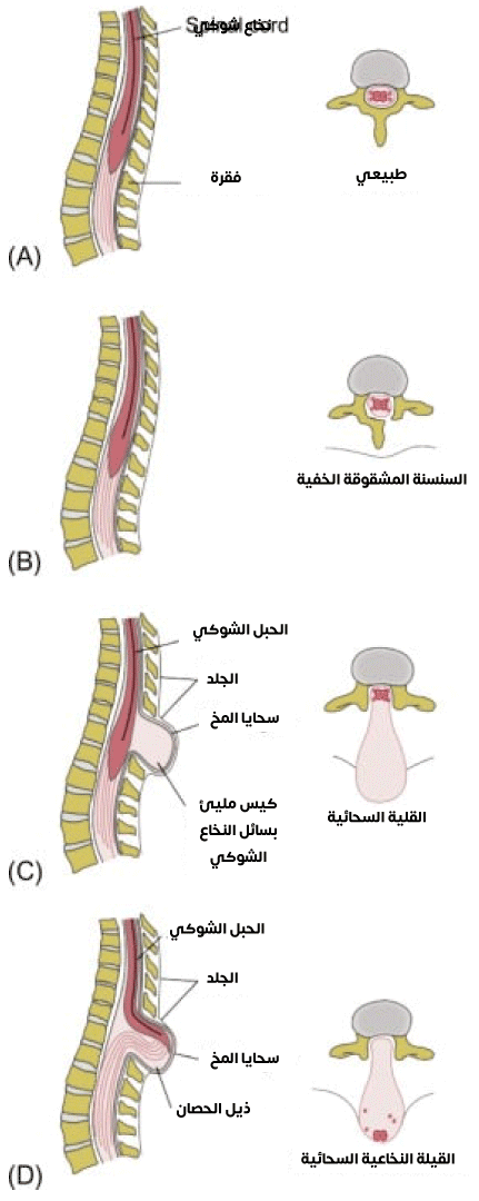 صورة لتشوهات الفقرات التي تسبب قيلات مختلفة من حيث المحتوى