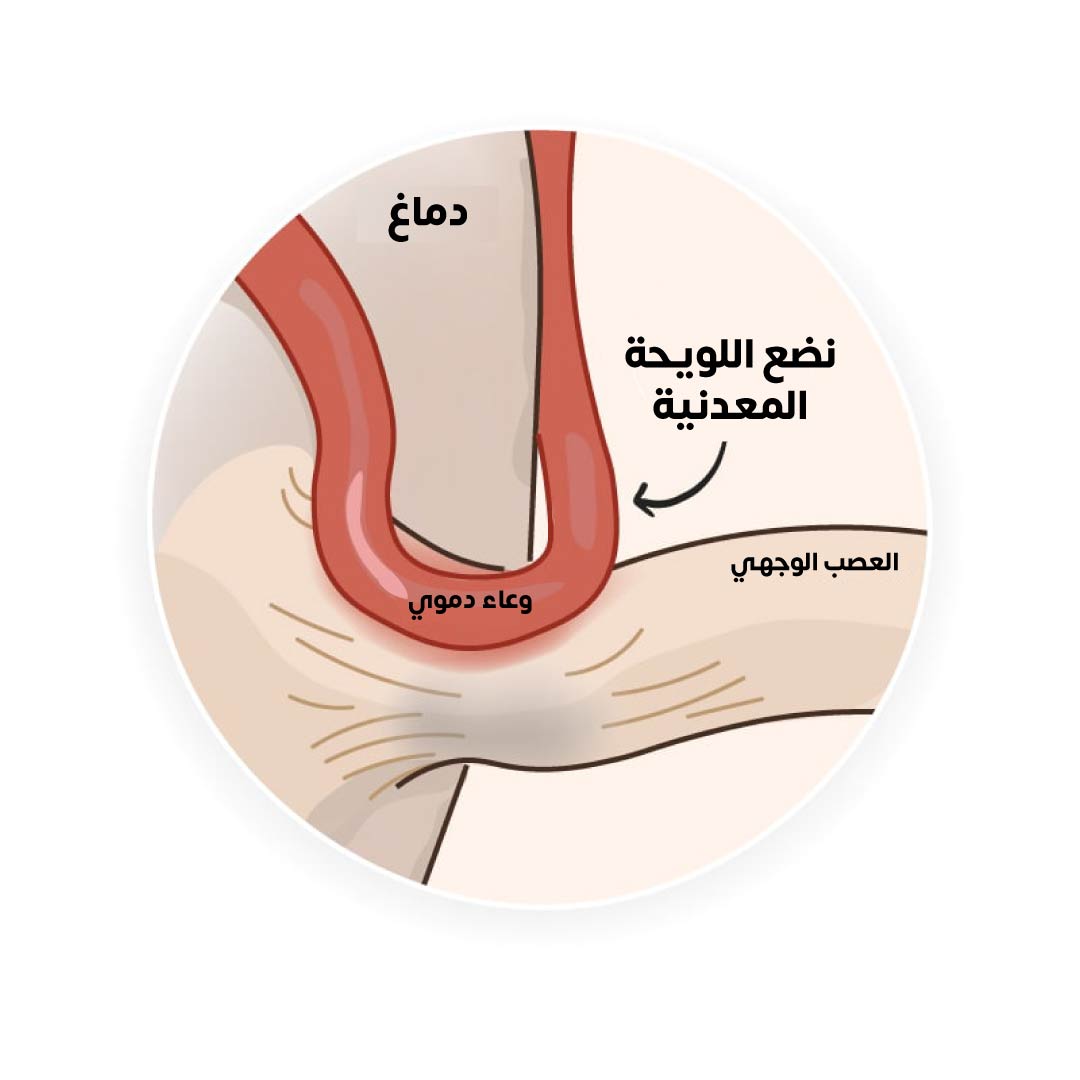 أحد أسباب حدوث تشنج الوجه النصفي هو الوعاء الدموي الضاغط على العصب الوجهي، ويتم العلاج في هذه الحالة عبر إجراء تداخل جراحي ووضع لويحة معدنية بين الوعاء والعصب بشكل دقيق للغاية