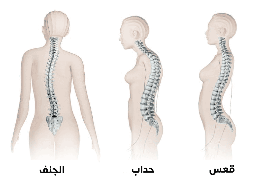 الفرق بين تشوهات العمود الفقري المختلفة