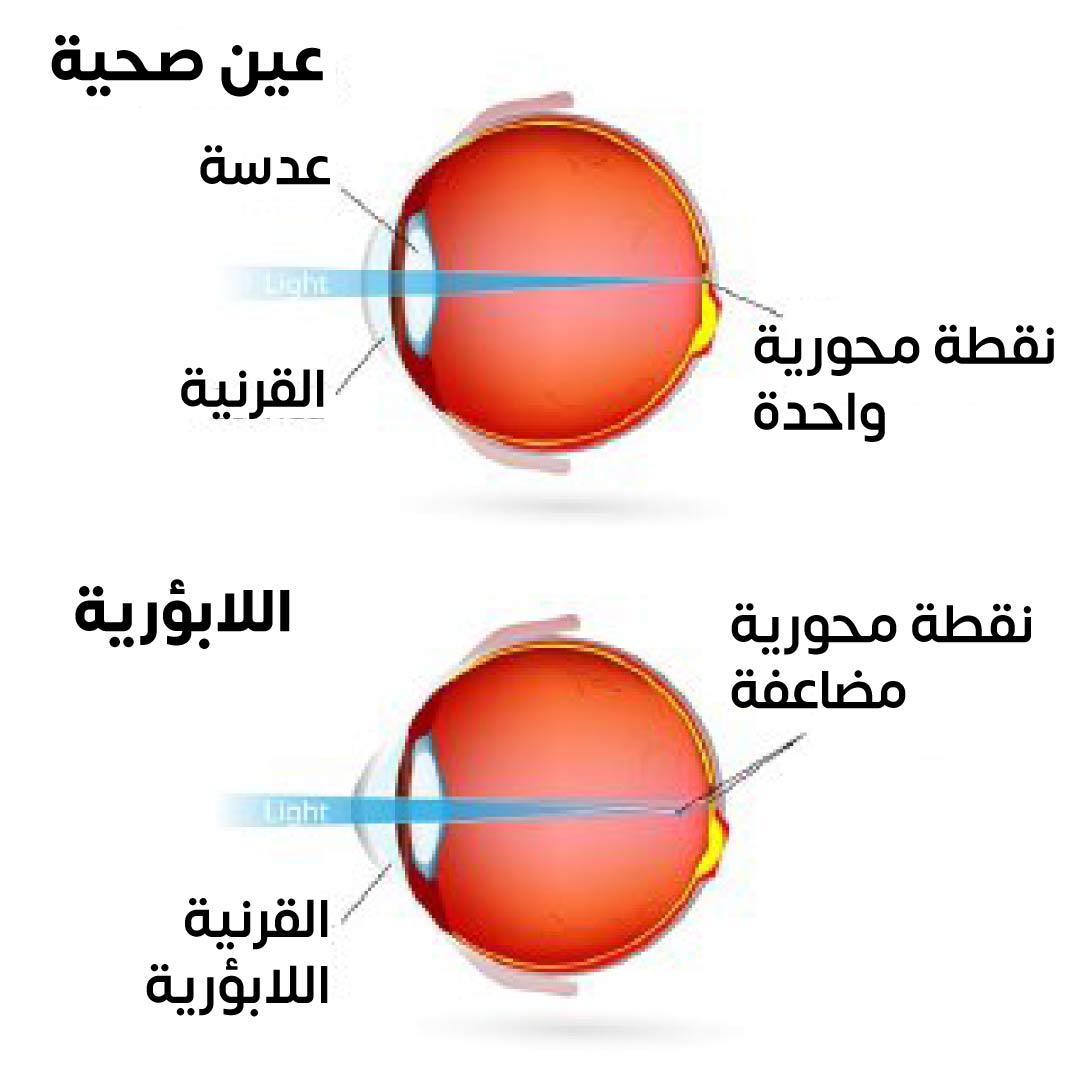 علاج الاستجماتيزم (اللابؤرية)