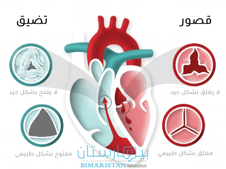 في حالة قصور الصمام فإن الصمام لا يغلق بشكل جيد بينما في حالة تضيق الصمام فإن الصمام لا يفتح بشكل جيد