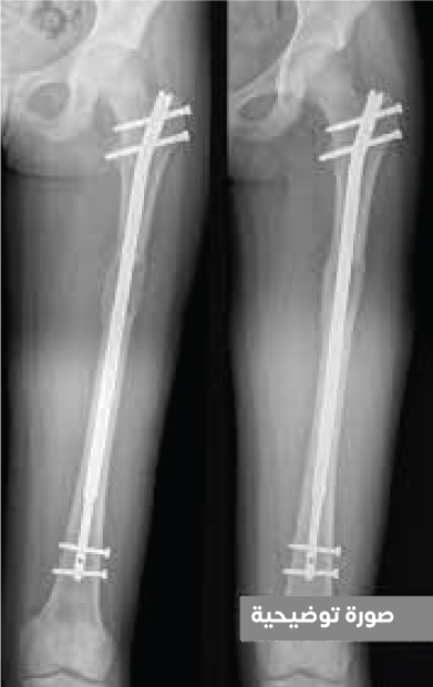 صورة شعاعية تُظهر المسمار الداخلي الذي يوضع جراحياً داخل العظم ليتم بعدها تطويل العظام عن طريقه