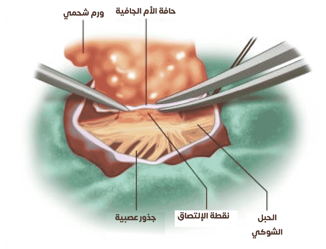 صورة توضح عملية فك التصاق الحبل الشوكي الذي التصق بورم شحمي