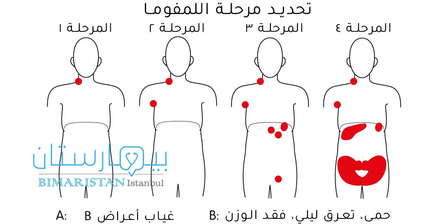 مراحل سرطان لمفوما هودجكن