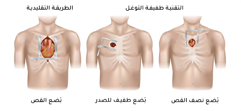 يمكن إجراء عملية تبديل الصمام الأبهري بالطريقة التقليدية عبر بضع القص أو بواسطة تقنيات أخرى طفيفة التوغل