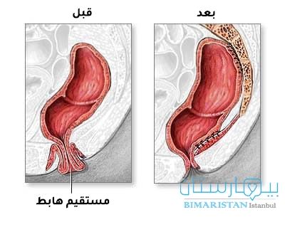 مقارنة بين حالة هبوط المستقيم والحالة الطبيعية بعد عملية إصلاح هبوط المستقيم