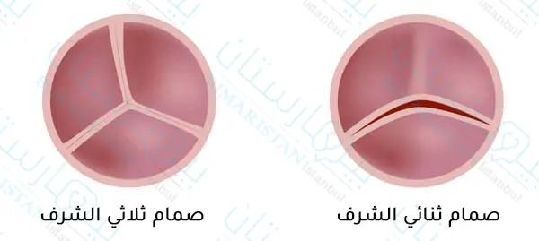 يتألف الصمام ثنائي الشرف من وريقتين بينما يتألف الصمام ثلاثي الشرف من ثلاث وريقات