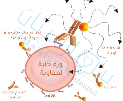 العلاج المناعي الشعاعي ضد سرطان لمفوما هودجكن