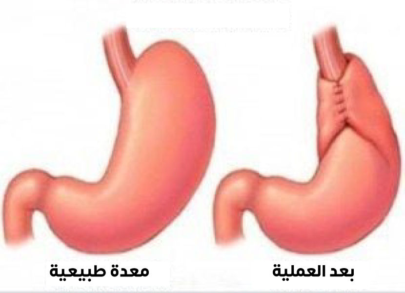 قبل وبعد عملية نيسن المستخدمة في علاج فتق الحجاب الحاجز ومنع ارتجاع المريء