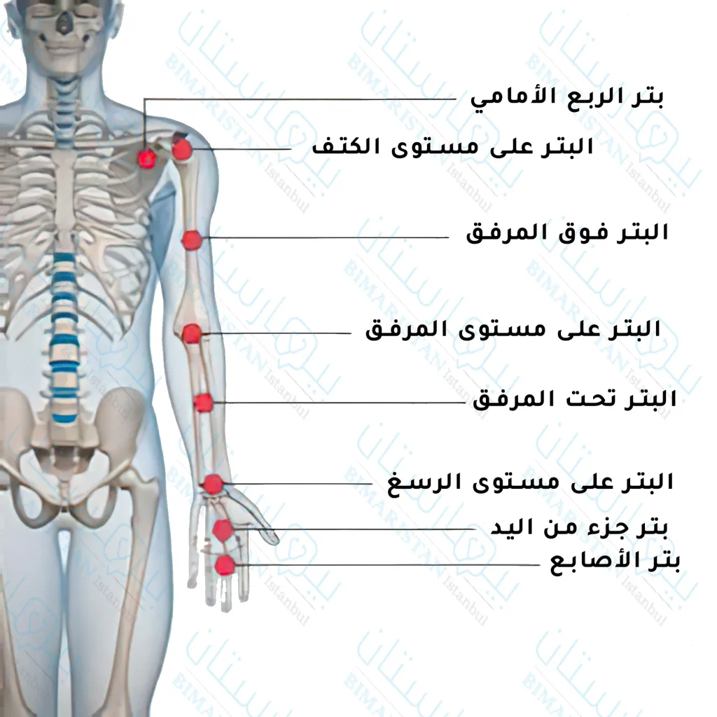 صورة لمستويات عملية البتر في الطرف العلوي