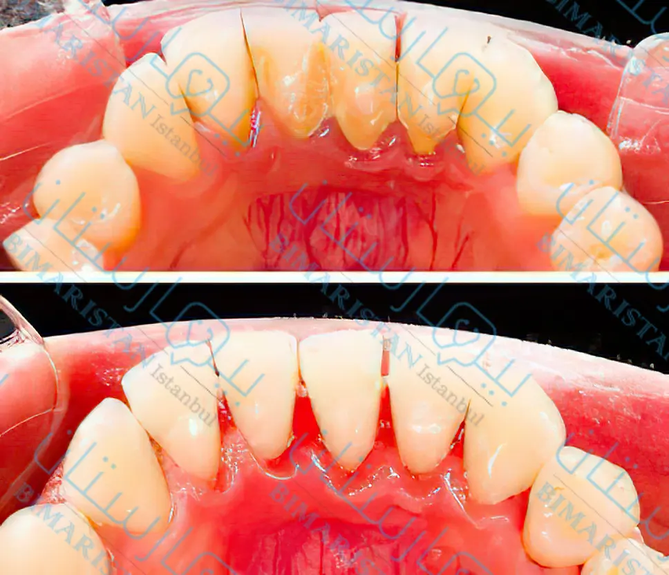 تنظيف الأسنان واللثة من الجير في تركيا