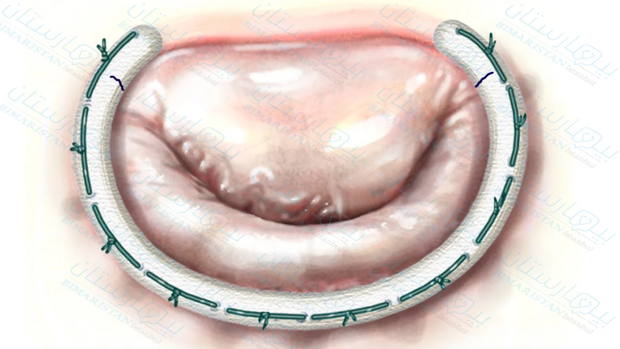 تم إجراء عملية إصلاح الصمام التاجي باستخدام حلقة غير كاملة لتدعيم مكان ارتكازه