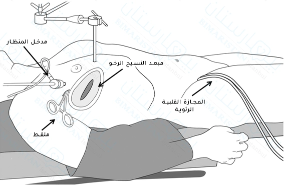 تتم العملية من خلال ثقب صغير في الورب الخامس الأيمن يدعى ثقب المفتاح