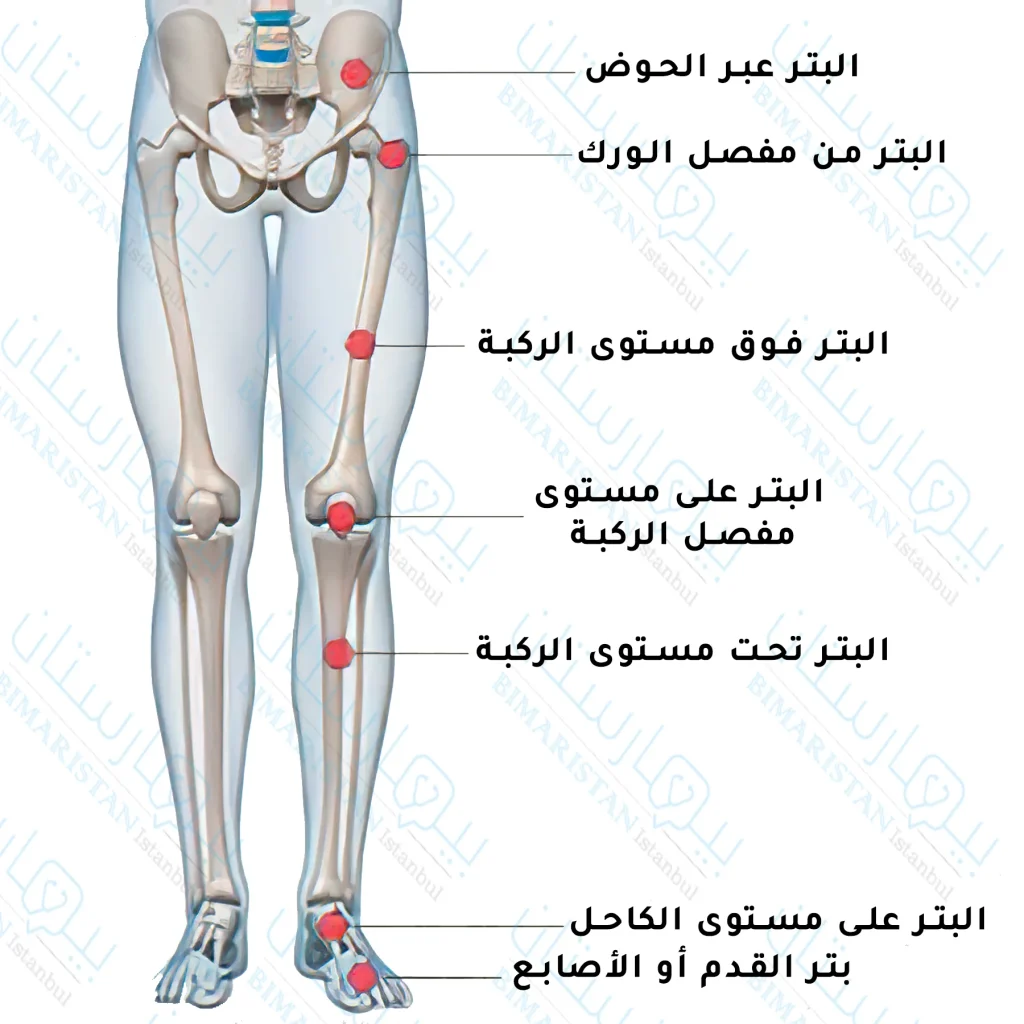 صورة للأطراف السفلية عند الإنسان توضح مستويات عملية البتر