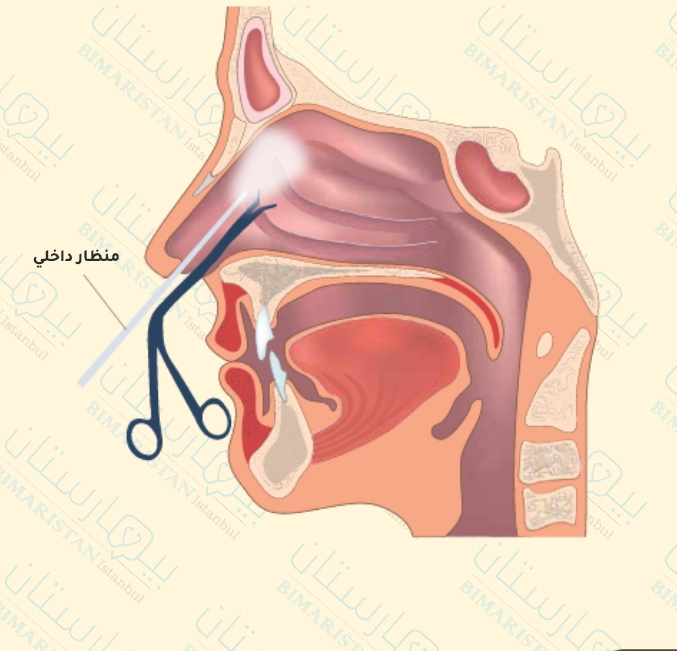 التنظير الوظيفي للجيوب الأنفية Fess لعلاج التهاب الجيوب الأنفية في تركيا