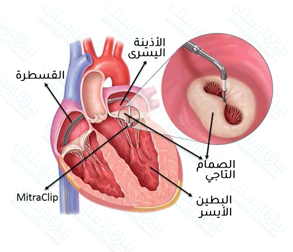 تم إصلاح الصمام التاجي عبر ربط وُرَيْقتيه بواسطة مشبك الصمام التاجي