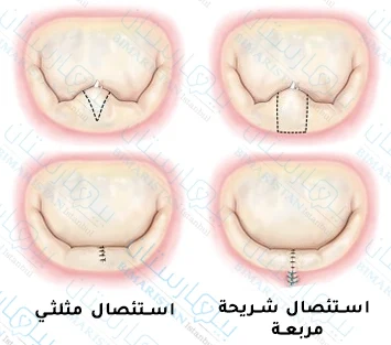 لاحظ عدم وصول حواف الاستئصال إلى حلقة الصمام في الاستئصال المثلثي بينما يتم استئصال جزء من حلقة الصمام عند استئصال شريحة مربعة