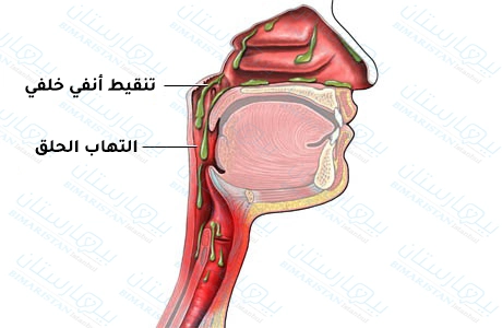 التنقيط الأنفي الخلفي إلى أسفل الحلق