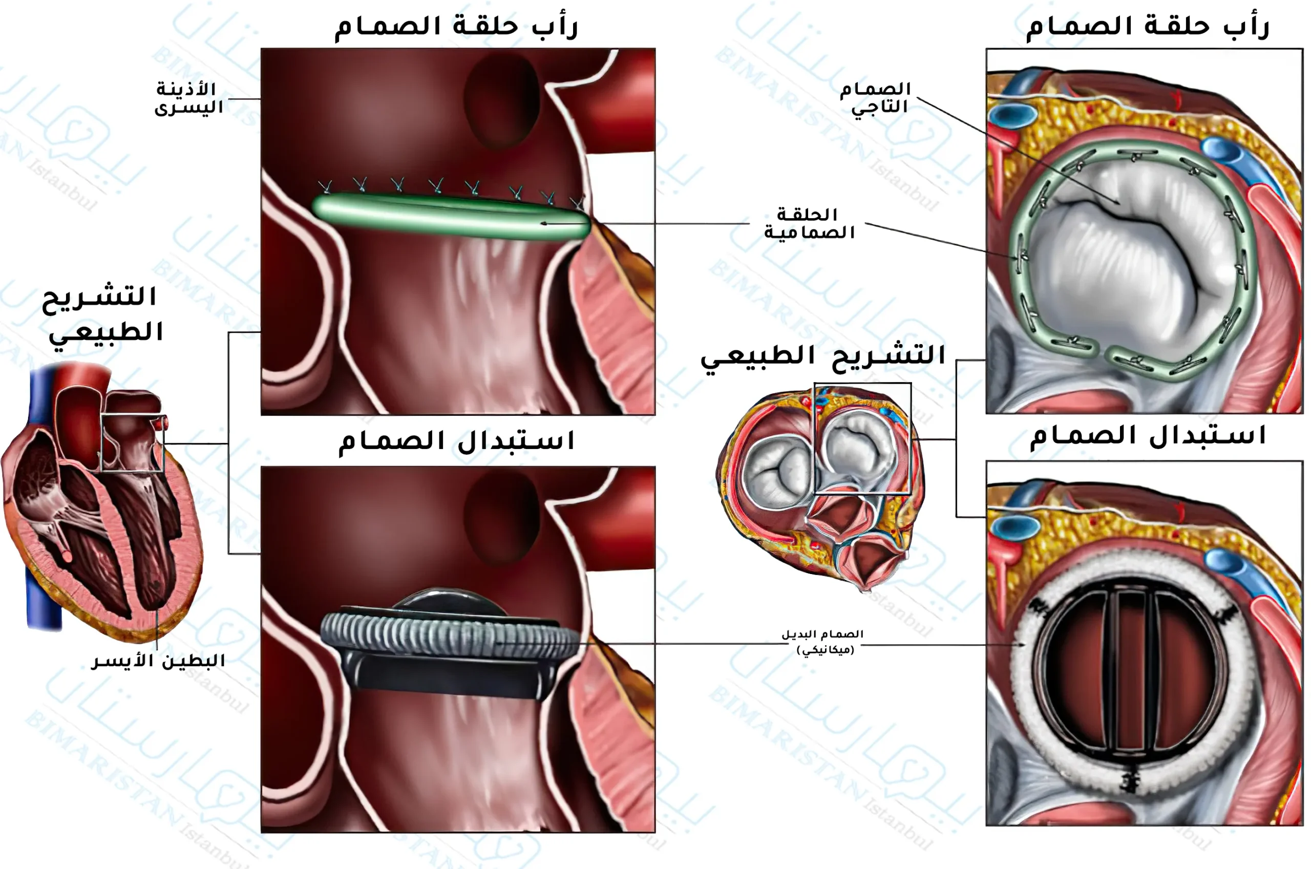 لا شك أن إصلاح الصمام أفضل من استبداله بصمام صنعي لكنه غير مناسب لجميع المرضى