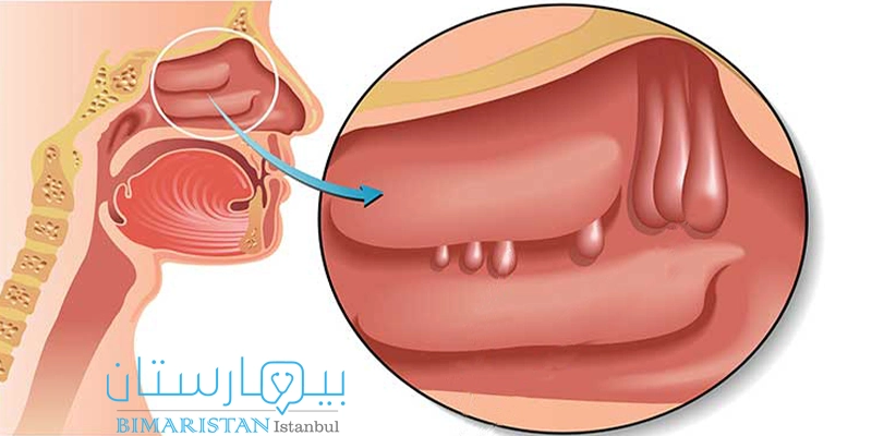 السلائل الأنفية في الممرات الأنفية