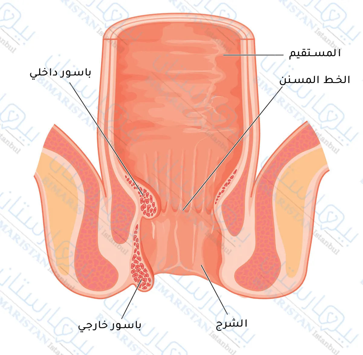 تنشأ البواسير الداخلية في المستقيم أو القناة الشرجية بينما يمكن رؤية البواسير الخارجية حول فتحة الشرج