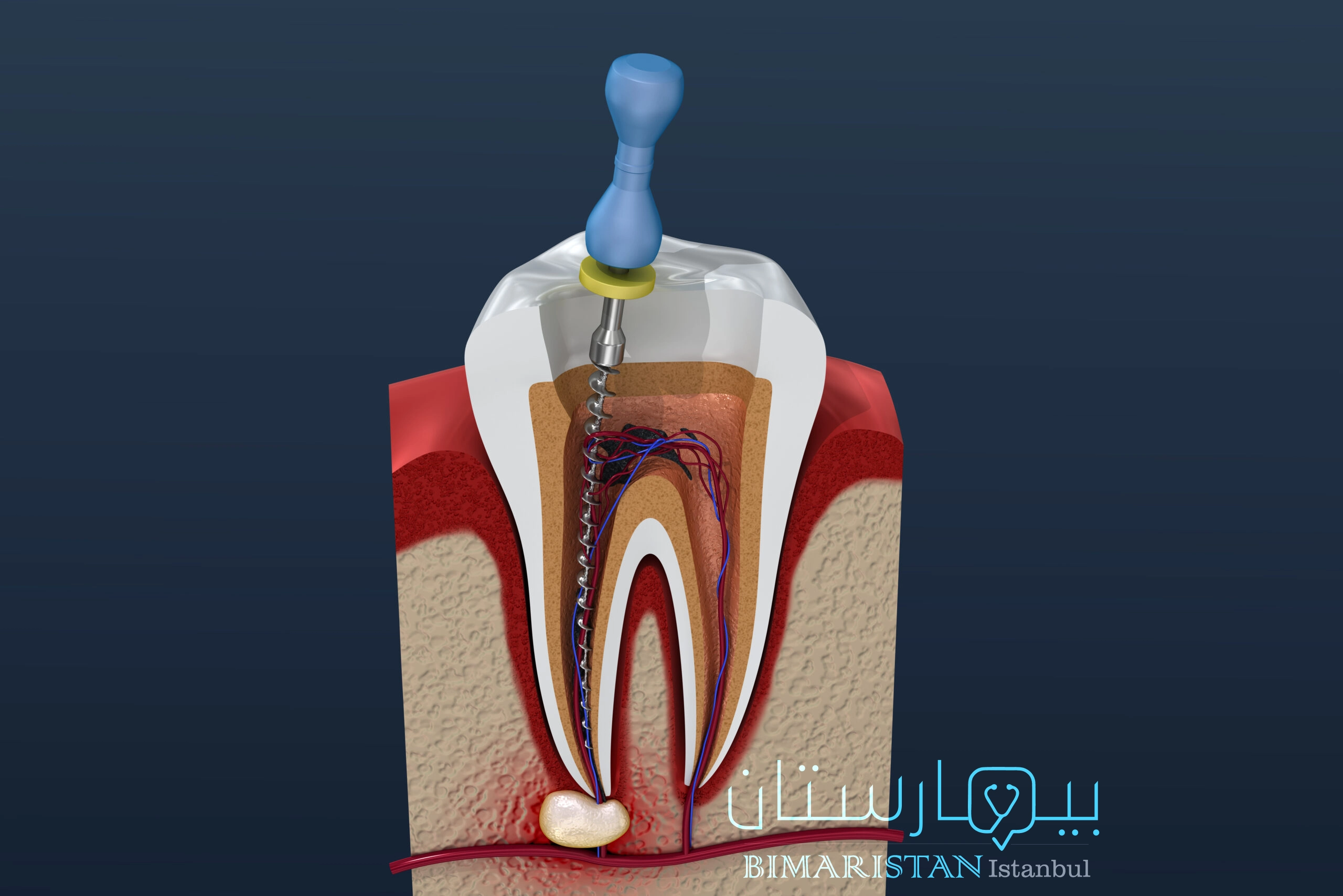 تنظيف قناة السن بالمبرد