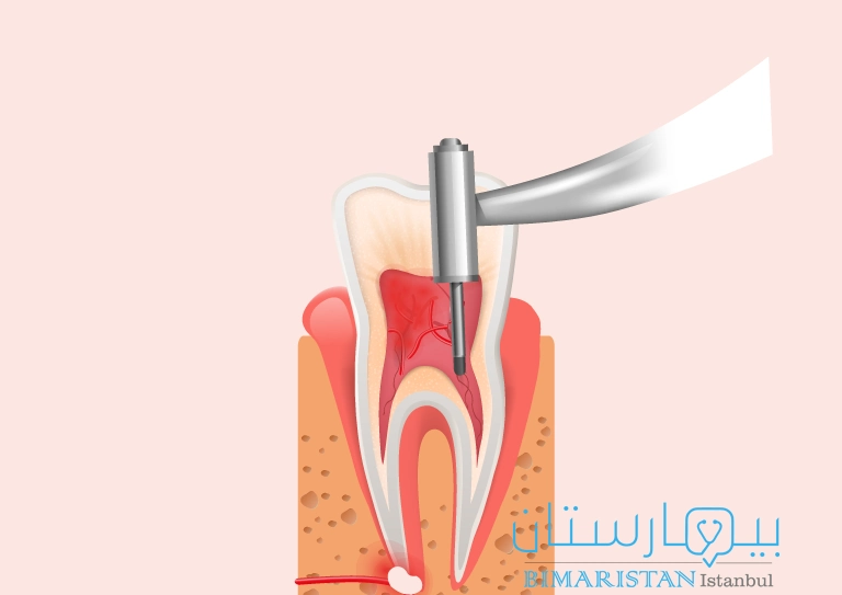 فتح حجرة السن