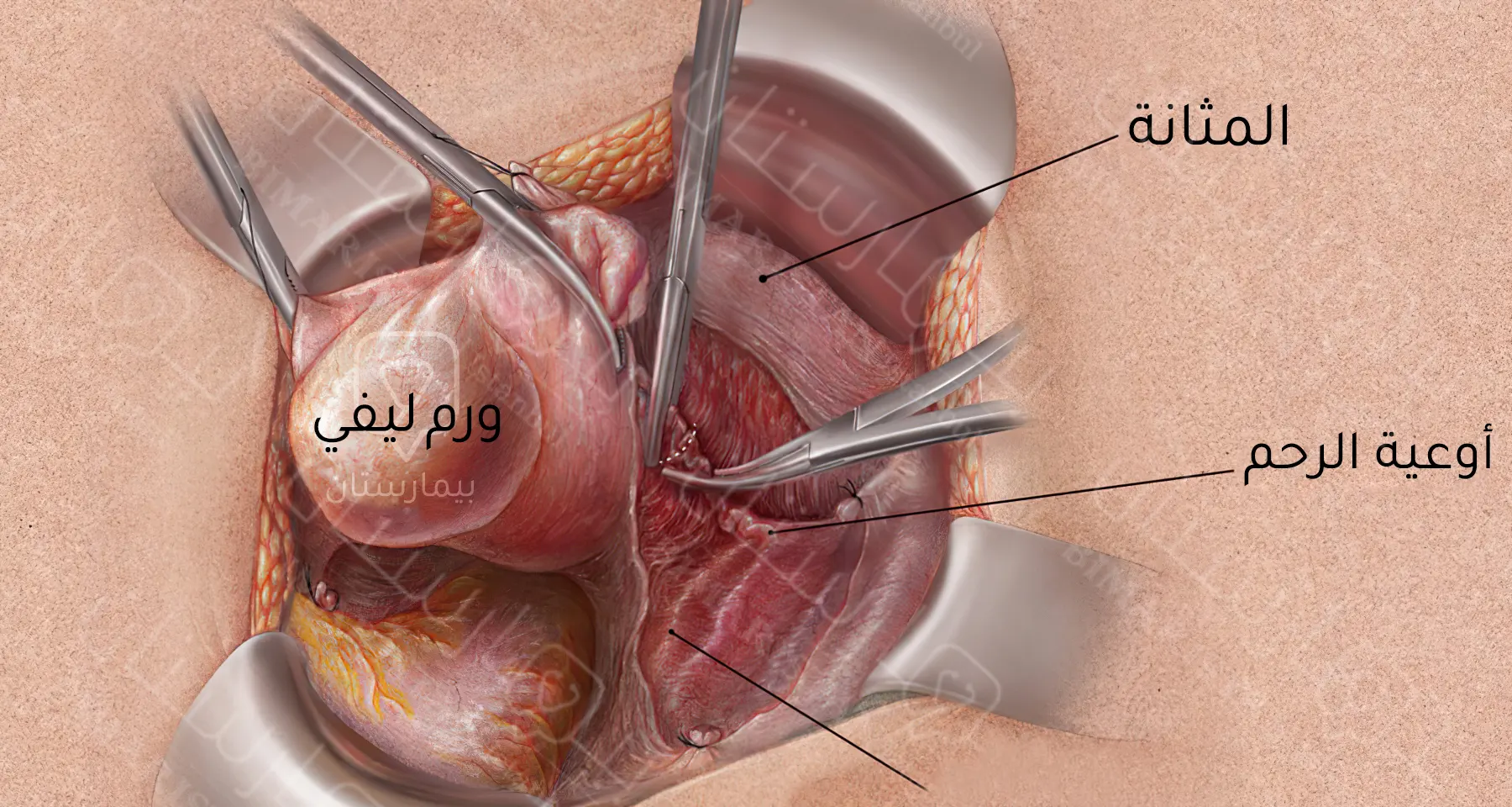 عملية استئصال الرحم بالصور