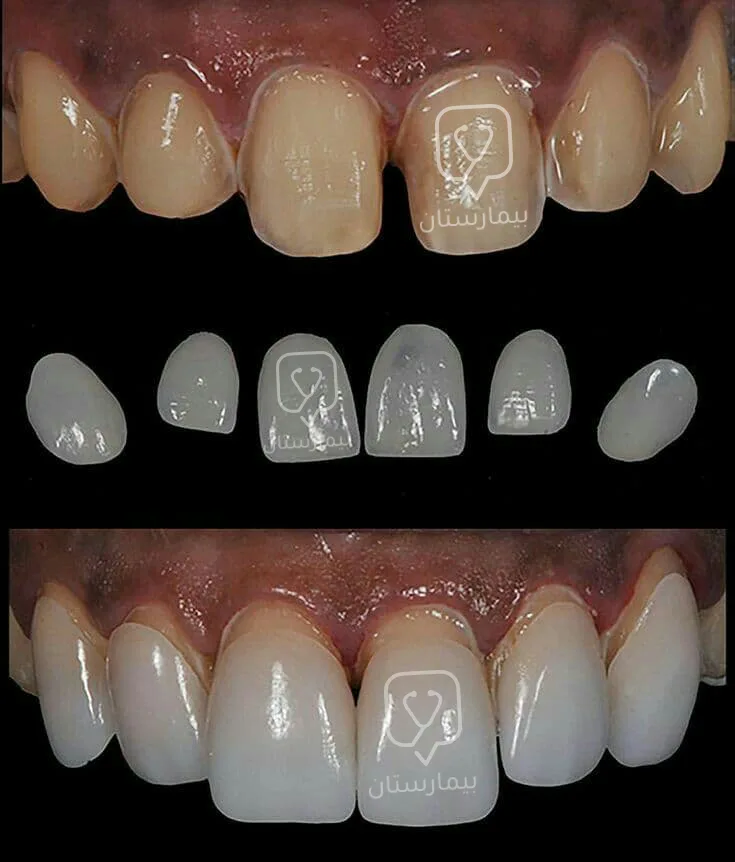 تظهر الصورة كيف تبدو الأسنان بعد تركيب عدسات الفينير