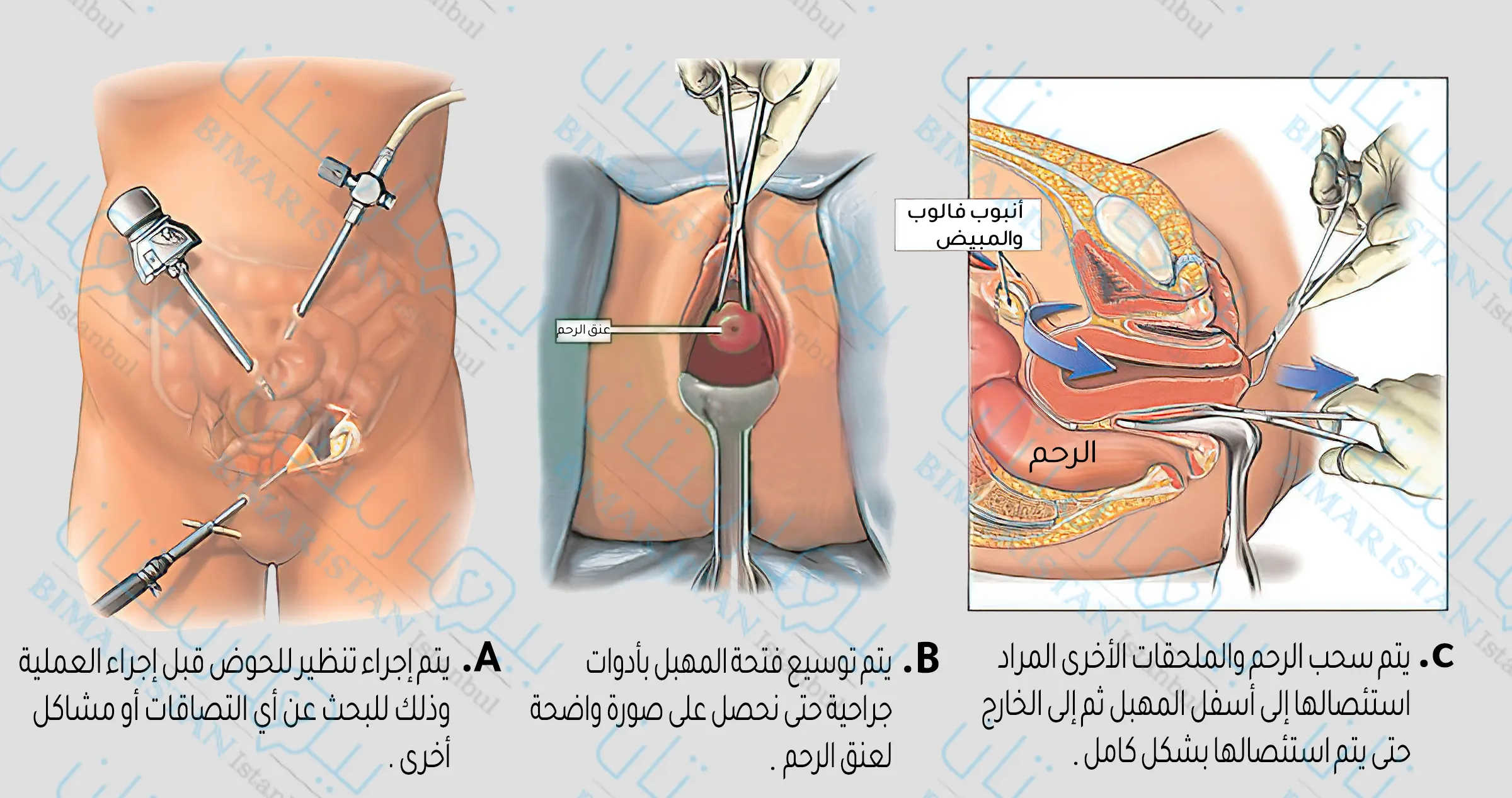 عملية استئصال الرحم بالصور