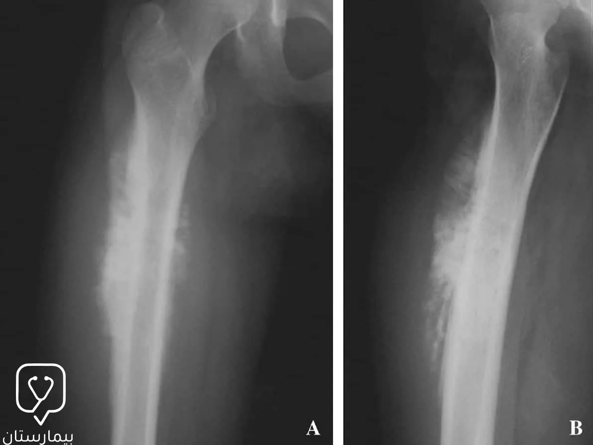 صورة بالأشعة السينية تظهر فيها كثافات حول العظم حيثُ أنه من المهم ان يتم الكشف مبكراً عنه حتى يتم علاج سرطان العظم بشكل أكثر فعالية