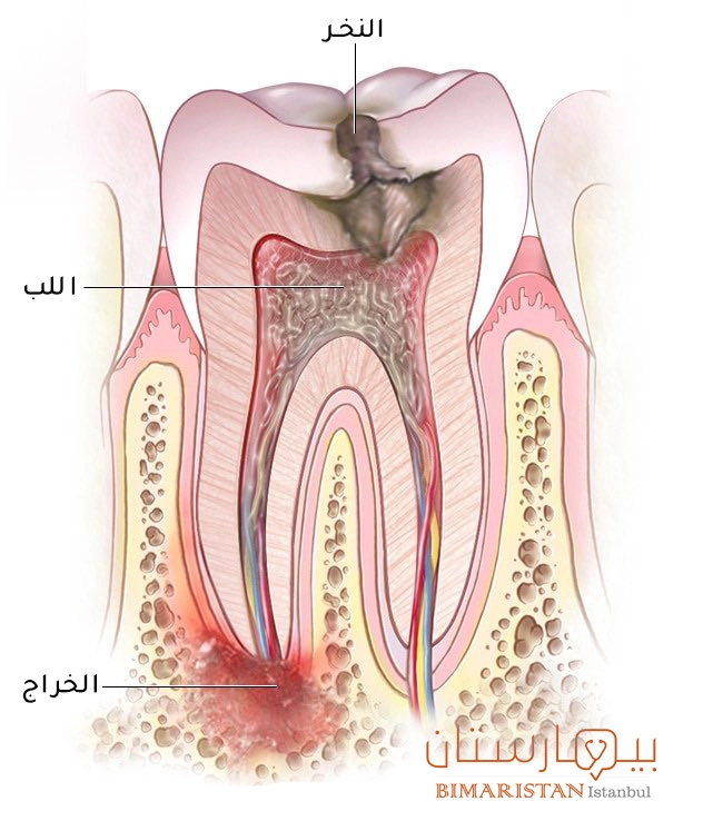 عدم علاج النخر قد يؤدي لظهور خراج الأسنان