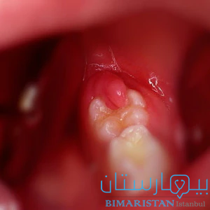 جزء اللثة المغطي للسن يدعى بالقلنسوة اللثوية